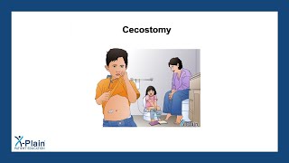 Cecostomy [upl. by Ymrej43]