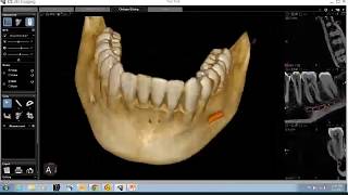 CS 3D Imaging Software Training CBCT Anatomical Review of the Mandible [upl. by Verneuil]