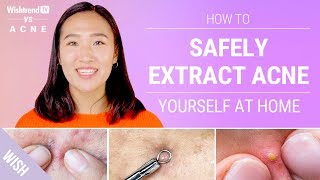 Proper Acne Extraction Steps Without Leaving a Scar  Wishtrend TV vs ACNE Feat Beauty Within [upl. by Arahd]