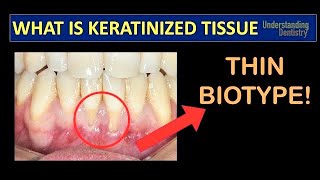 Gingival Recession Treatment How to Check the Keratinized Gingival Tissue Periodontal Maintenance [upl. by Derrej]