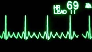 Atrial Flutter YouTube [upl. by Osrit]