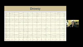 Understanding EEG A Practical Guide for Patients and Families [upl. by Yhtur]