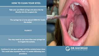 PostOperative Video Irrigation for Extraction and Wisdom Teeth [upl. by Rheta]