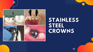 PEDIATRIC DENTISTRY  STAINLESS STEEL CROWNS [upl. by Bail]