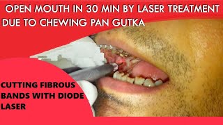 Laser Cutting of Fibrous Band of OSMF Patient ORAL SUBMUCOUS FIBROSIS TREATMENT [upl. by Raknahs]