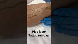 Picosecond laser tattoo removal TattooRemoval picolaser LaserTreatment beauty tattoo too [upl. by Brigette]