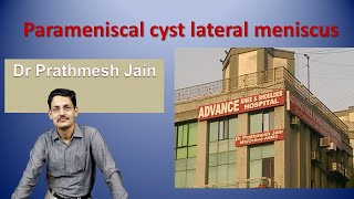 tushar parameniscal cyst [upl. by Pages]