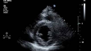 Hypokinesis Mitral Regurgitation Aortic Insufficiency [upl. by Krever]