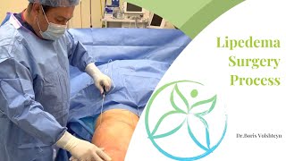 Lipedema Surgery Process  Lipedema Treatment NJampNY  Dr Boris Volshteyn [upl. by Lora483]