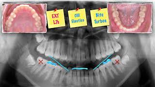 Keys to Anterior Crossbite correction｜【Chris Chang Ortho】CC734 [upl. by Ahsilet]