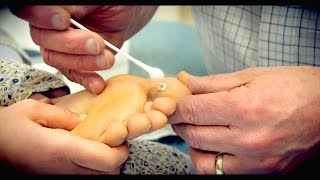 Freezing a HUGE PLANTAR WART with liquid nitrogen  Dr Paul [upl. by Roee81]