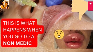 NON MEDIC Lip Filler Results MakeMePreety Beauty Treatment Clinic Uxbridge [upl. by Ayetal]