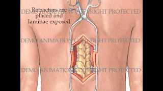 Transpedicular Thoracic Corpectomy [upl. by Allekim674]