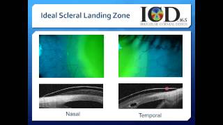 Scleral Contact Lenses Video 5 [upl. by Herb]