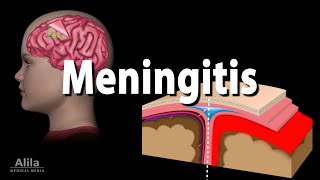 Meningitis Pathology Causes Symptoms Diagnosis and Treatment Animation [upl. by Acsicnarf]