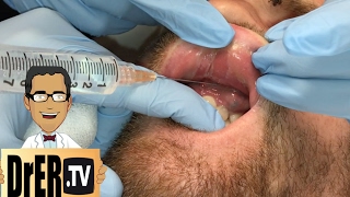 gum abscess drainage  Full VIDEO [upl. by Menon56]