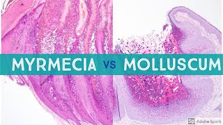 Molluscum vs Myrmecia Wart  Dermpath Lookalikes [upl. by Ataner]