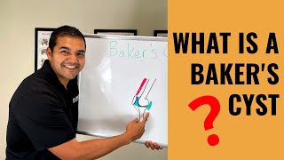 What Is A Baker’s Cyst Swelling Behind The Knee [upl. by Balcer]