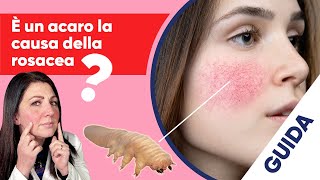 Cos’è la rosacea cause e trattamenti mirati [upl. by Mikiso]