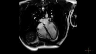 Cardiac MRI scan of a heart beating in high resolution  ECG gated CMRI in HD  real time scan [upl. by Maurilia]