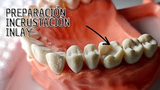 Preparación Incrustación dental Inlay [upl. by Enneirb]