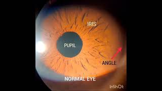 Laser Peripheral Iridotomy for Angle closure glaucoma [upl. by Cleres]