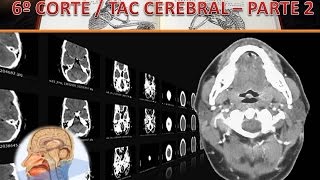 TAC Cerebral corte 6 parte 2 [upl. by Ofloda]