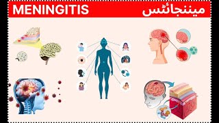 meningitis  mannjites  मेनिंजाइटिस [upl. by Doone]