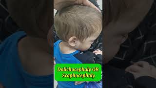 Dolichocephaly  Scaphocephaly Saggital craniosynostosis  abnormal head shape craniosynostosis [upl. by Watt189]