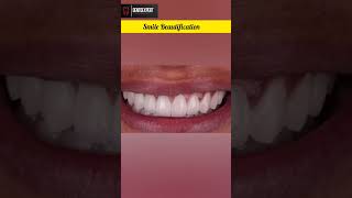 Microdontia  Yellow Stained Teeth  Gummy Smile  Tilted Incisor Treatment shorts dentist viral [upl. by Honebein]