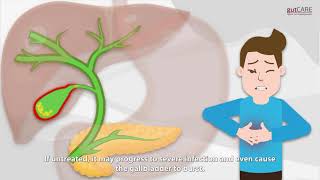 Gallstones 101  Not A Normal Gastric Pain  GUTCARE [upl. by Reeva143]