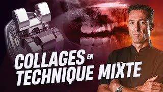 Orthodontie lingual et vestibulaire  collage en technique mixte 🦷 [upl. by Anitsugua]