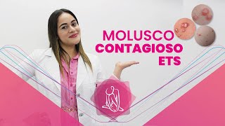 Molusco Contagioso ETS [upl. by Sumetra]