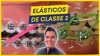 COMO TRATAR A CLASSE 2 COM ELÁSTICOS PASSO A PASSO [upl. by Elttil]