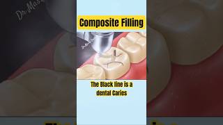 COMPOSITE FILLING on Molar tooth [upl. by Artenak127]