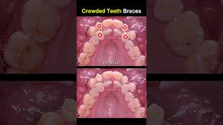 Complex braces for crowded teeth braces orthodontist dentist [upl. by Nido489]