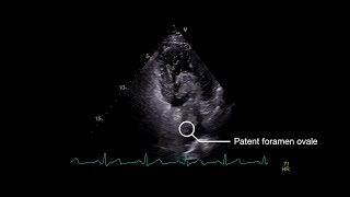 Stroke From Paradoxical Embolism Through a Patent Foramen Ovale [upl. by Davy986]