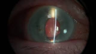 Examination of a corneal ulcer plus more [upl. by Eedahs]