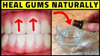 Cure Periodontal Disease At Home  Heal Gums Naturally [upl. by Kenimod]