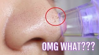 how to remove blackheads on nose naturally at home  black dots on the nose  Nose blackhead [upl. by Etterual]