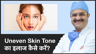 How To Treat Uneven Skin Tone Uneven Skin Tone का इलाज कैसे करें  ClearSkin Pune  In HINDI [upl. by Nilerual]