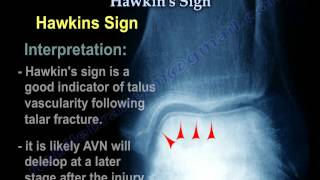 Talus Fracture  Hawkins Sign  Everything You Need To Know  Dr Nabil Ebraheim [upl. by Karlis610]