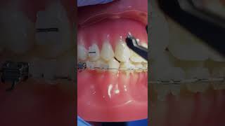 Orthodontics and Braces Improving Teeth Alignment [upl. by Enelyahs]