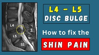 How to fix Shin pain due to lumbar L4  L5 disc bulges [upl. by Barnabe]