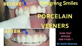 Dental treatment for yellow teeth  dental veeners  dental laminates  Fluorosis treatment [upl. by Thanos928]