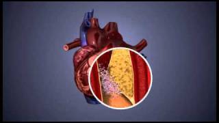 Atherosclerosis  3D Animation  ABP © [upl. by Hinman]