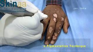 Vitiligo or Leucoderma Treatment Micropigmentation in India  Safed Daag Ka Ilaj │Skinaa Clinic [upl. by Auberbach908]