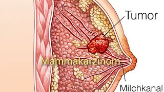 Mammakarzinom  Brustkrebs Ursache Symptome Risikofaktoren und Therapie [upl. by Falkner]