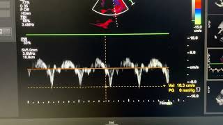 Annulus paradoxus motion in constrictive pericarditis [upl. by Anhsirk857]