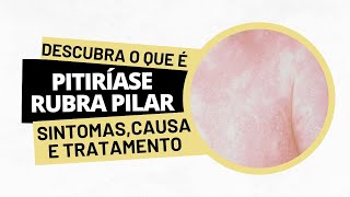 Pitiríase rubra pilar  Sintomas causa e tratamento [upl. by Vocaay]